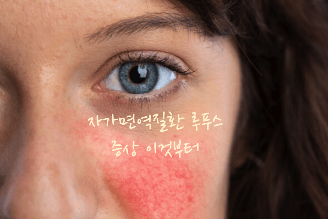 루푸스병 증상