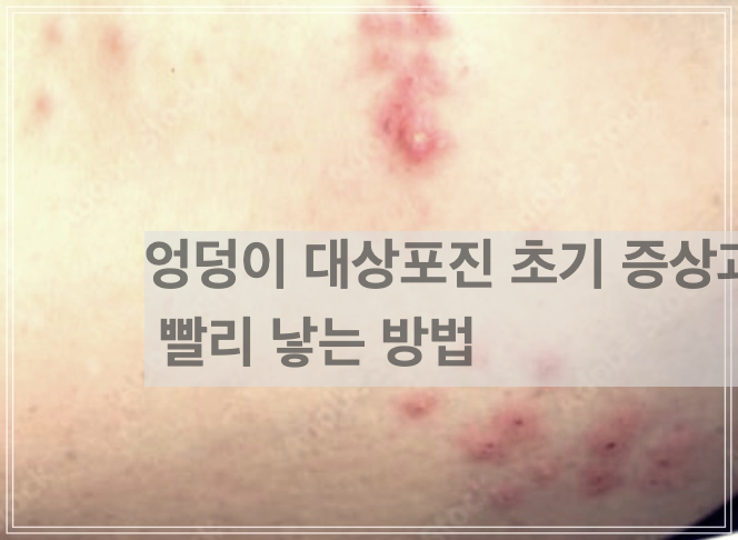 엉덩이 대상포진 초기 증상과 빨리 낳는 방법