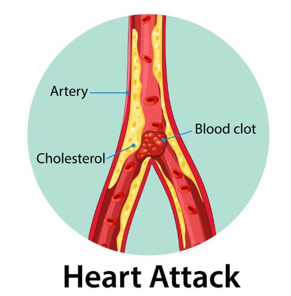 혈관에 지방으로 막혀 있는 모습