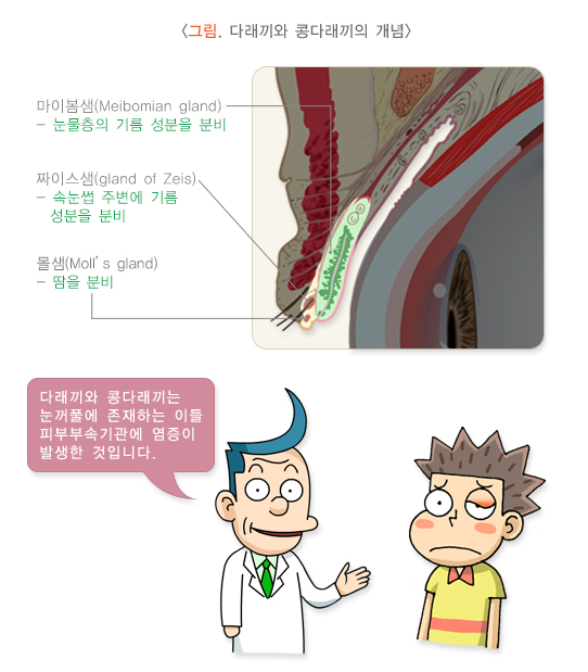 다래끼와 콩다래끼 개념 관련 이미지