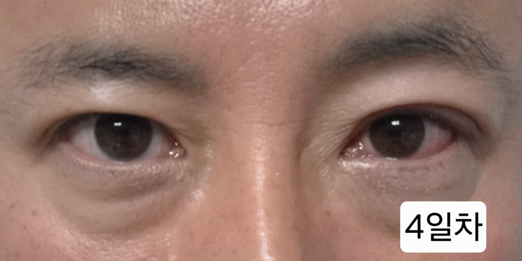 유행성각결막염 눈병 초기증상부터 12일차 치료 기록(진행 중)