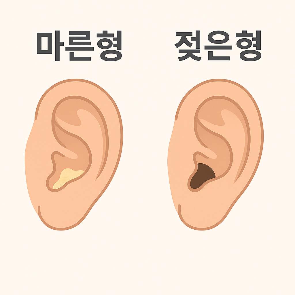 마른귀지 젖은귀지