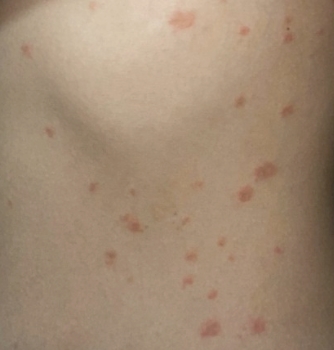 장미색 비강진 원인