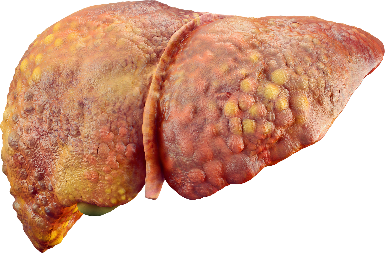 비알코올성 지방간 (NAFLD: Non-Alcoholic Fatty Liver Disease)