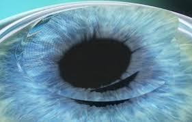 라식과 라섹 차이점