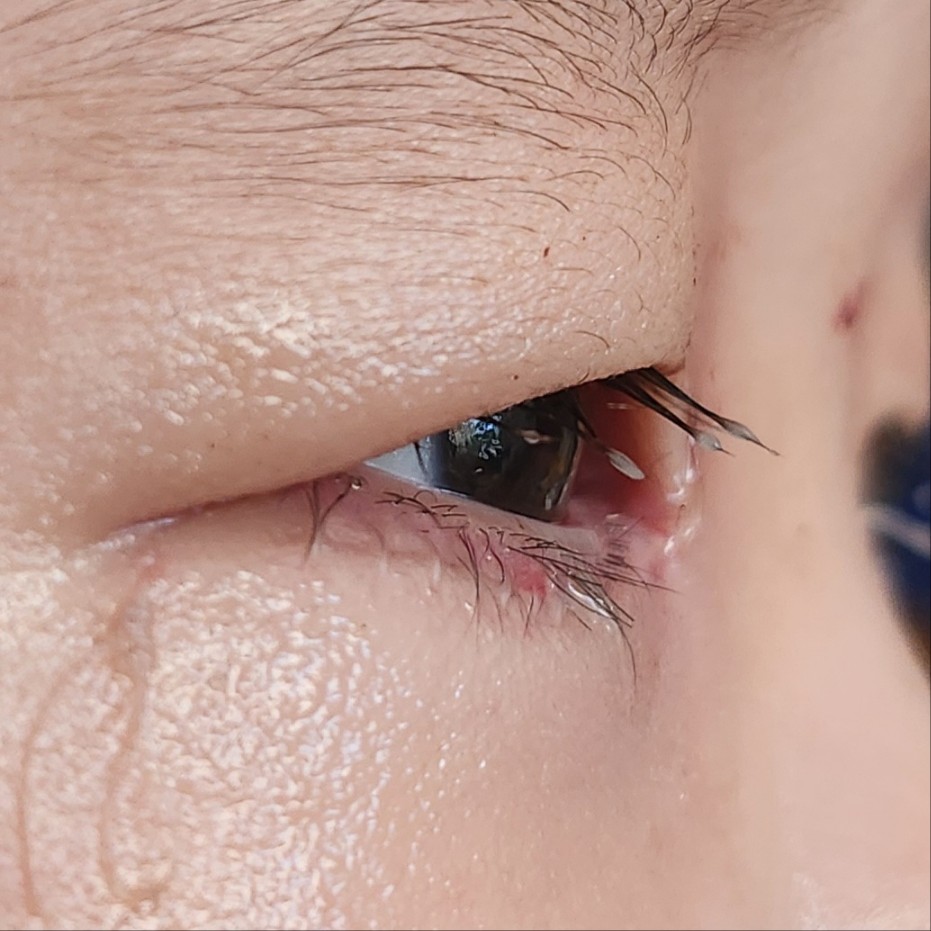 수술 2일 후 눈 옆모습