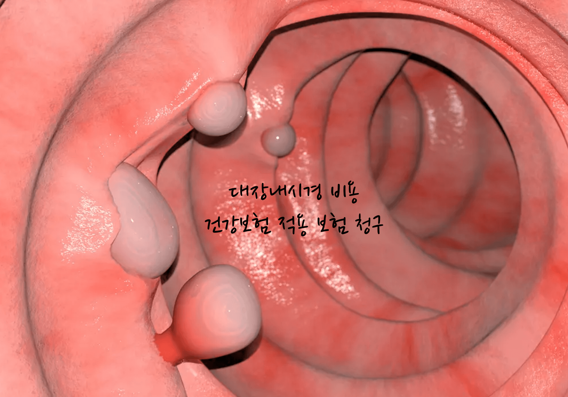 대장내시경 비용