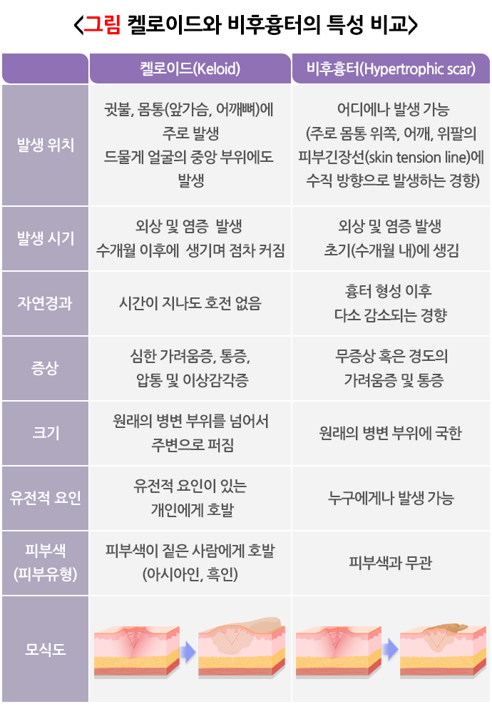 켈로이드와 비후흉터의 비교