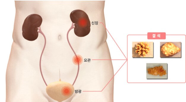위치별 요로결석 발생 부위