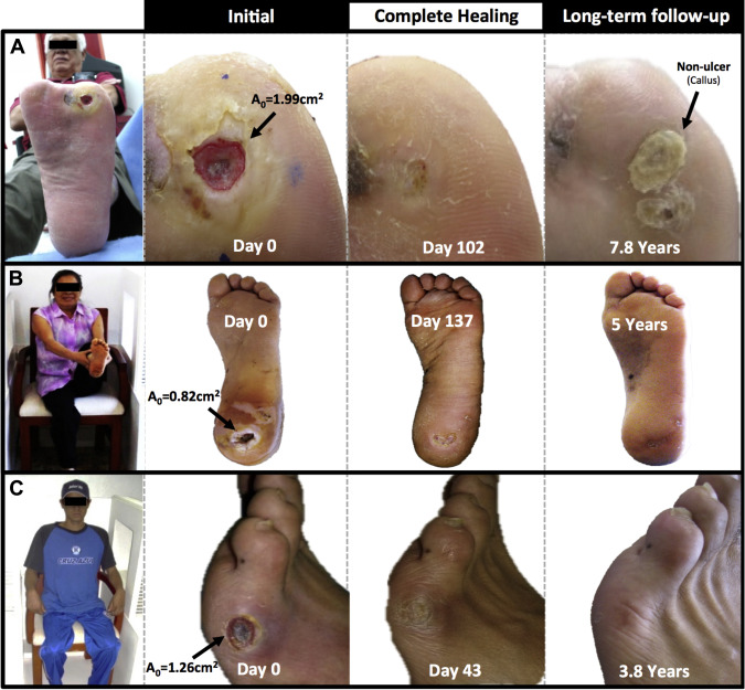 당뇨발-초기-증상-사진