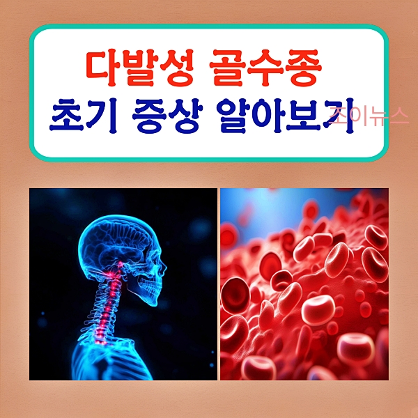 다발성 골수종의 초기 증상과 진단은?
