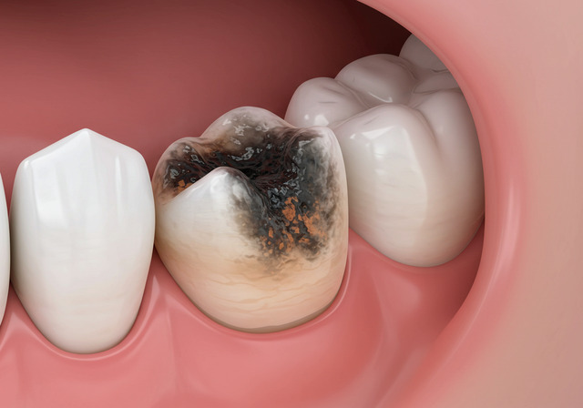 충치 냄새 나는 이유