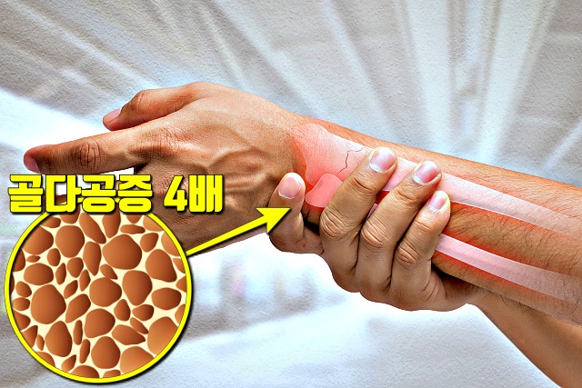 여성 골다공증 증상 원인, 건강 팁줌 매일꿀정보