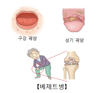 베체트 병에 좋은 음식 베체트 전문병원