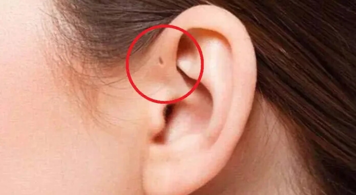 선천성 이루공 사진