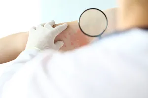 대상포진-초기증상