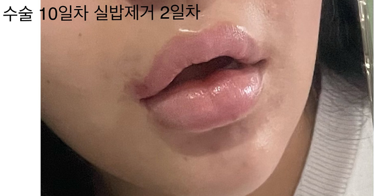 입술 축소수술 후기