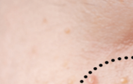 눈밑에 하얀 좁쌀