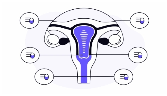 자궁근종 치료 과정