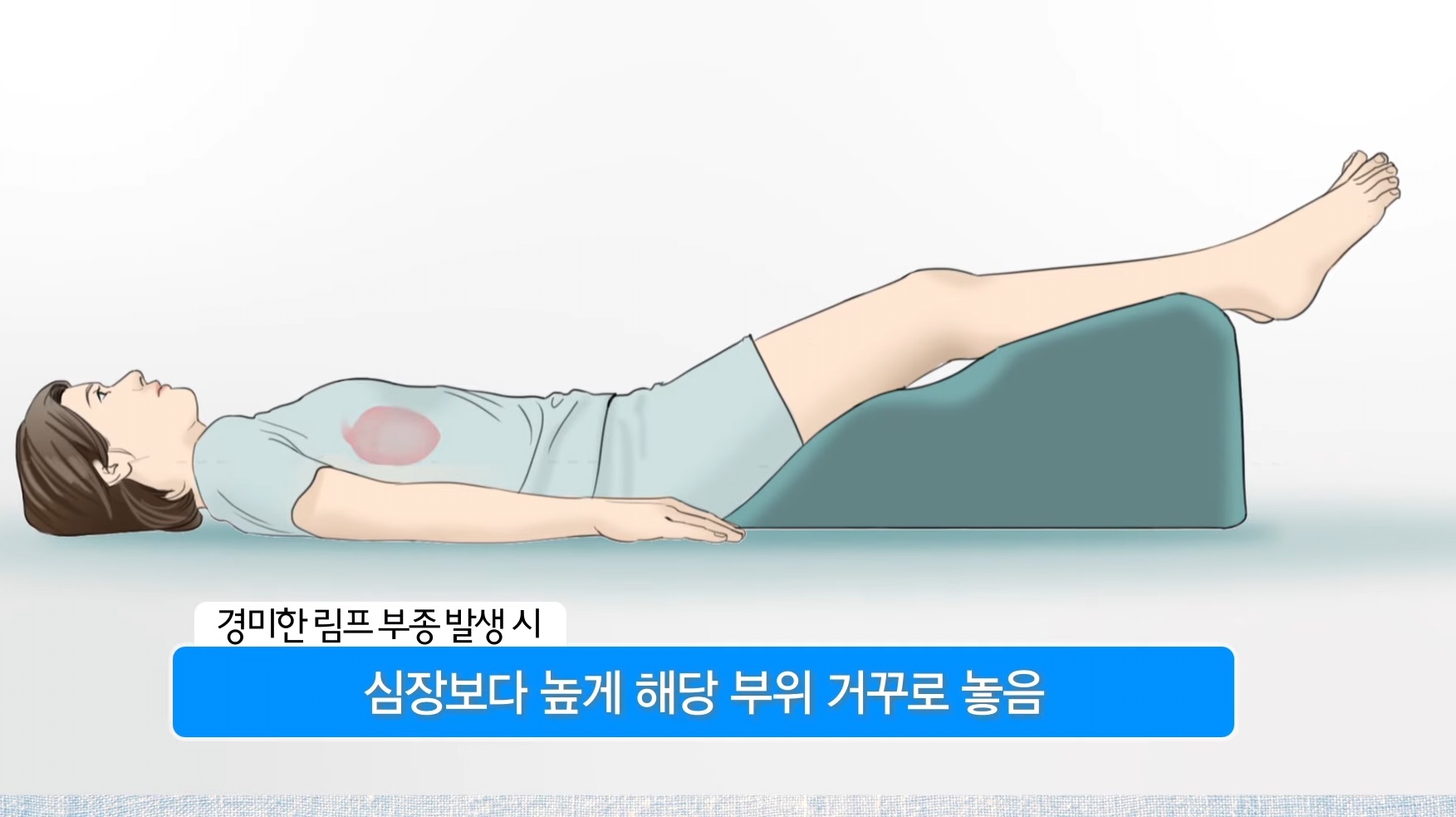 EBS-명의-림프-부종-