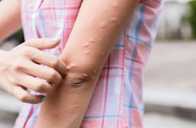 말라리아 증상&amp;#44; 모기 예방 행동 수칙&amp;#44; 백신 및 예방접종