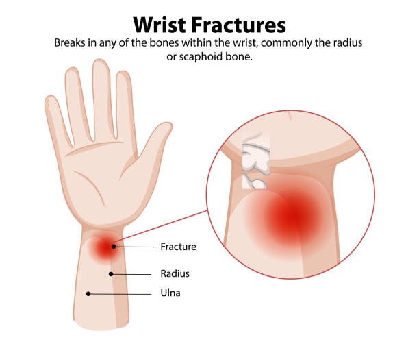 척골충돌증후군 원인