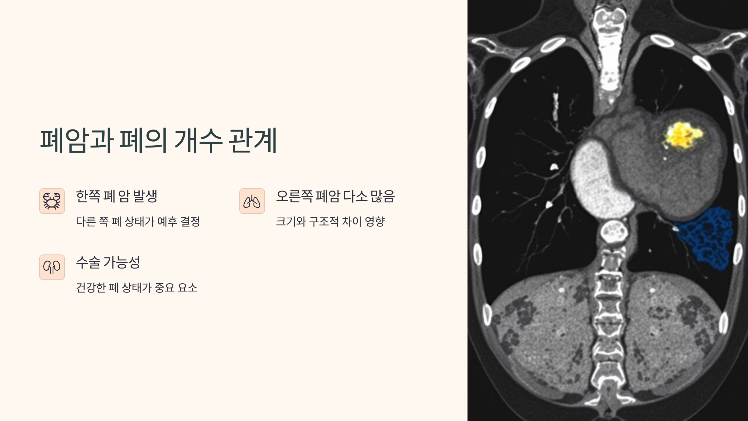 폐암과 폐의 개수 관계