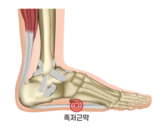 족저근막염 증상