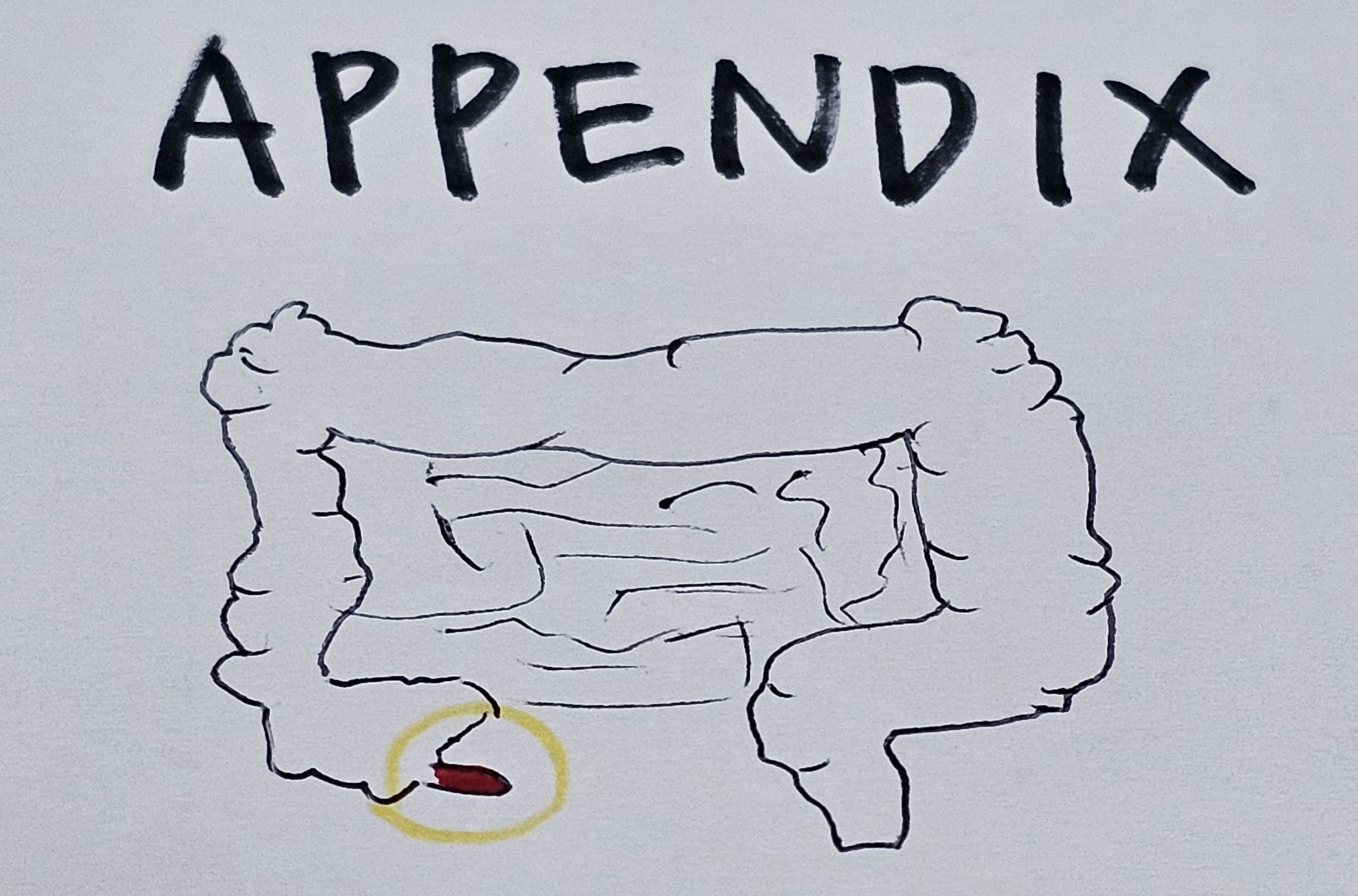 맹장염, 충수돌기염, Appendix, Appendicitis