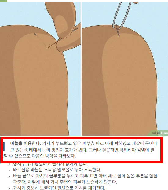 손가락 가시 빼는법 소개