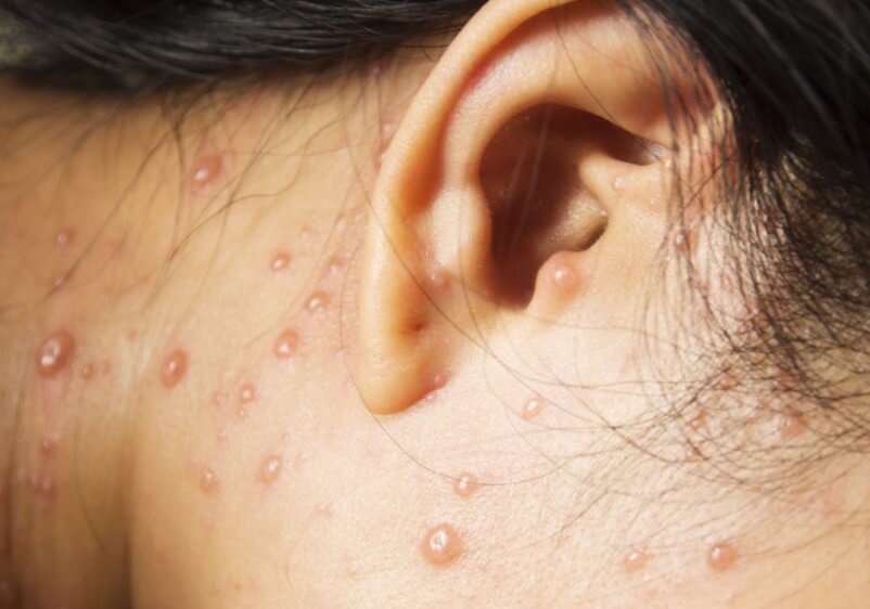 대상포진 초기증상 대상포진 조기치료 대상포진 초기증상 및 조기치료