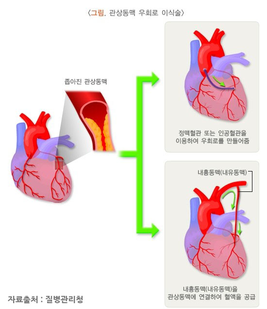 관상동맥 우회술(CABG)