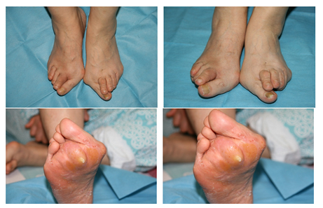 무지외반증 수술을 필요로 하는 심각한 경우