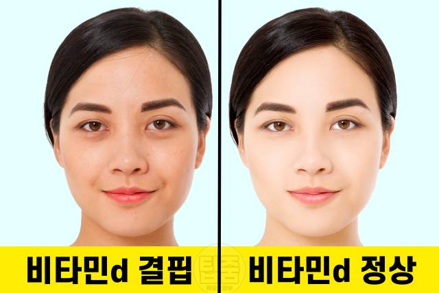 비타민d 결핍 증상 비타민d권장량 칙칙한 얼굴 다크서클