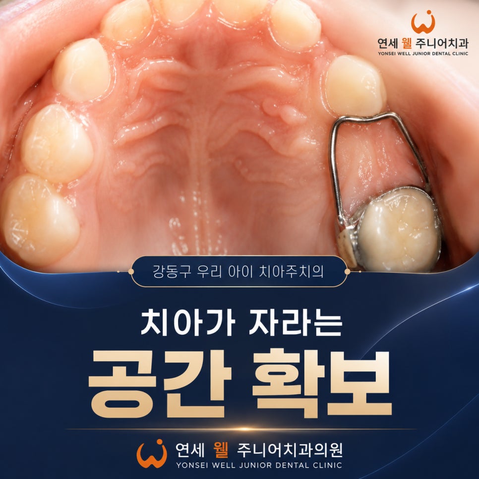 유치가 빠진 자리에 영구치 맹출 공간을 확보하는 소아 공간유지장치