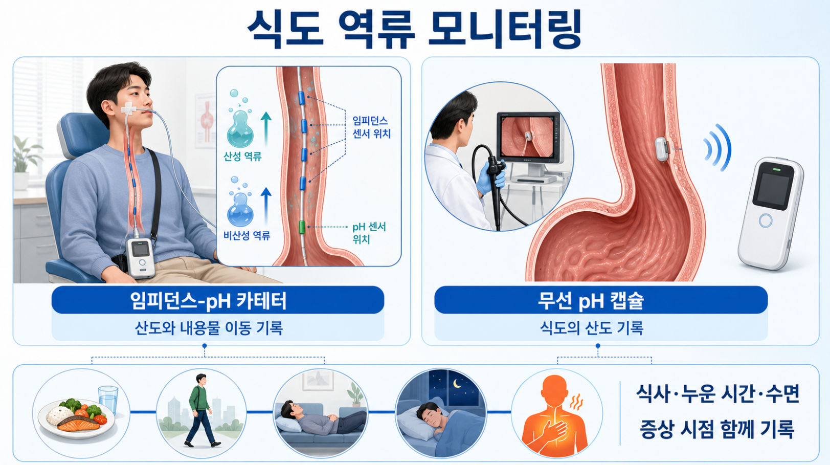 임피던스-pH 카테터와 무선 pH 캡슐을 이용한 식도 역류 모니터링 비교