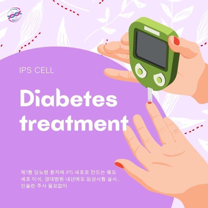 제1형 당뇨병 환자에 iPS 세포로 만든 췌도 세포 이식