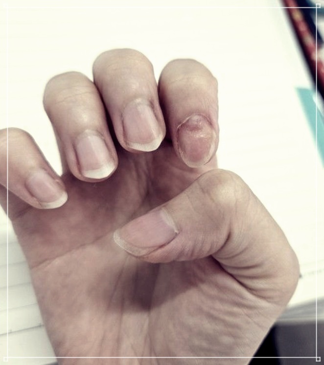 손톱 건강을 위한 일상 속 쉬운 손톱파임 예방법.