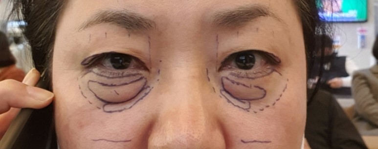 하안검 수술 후기