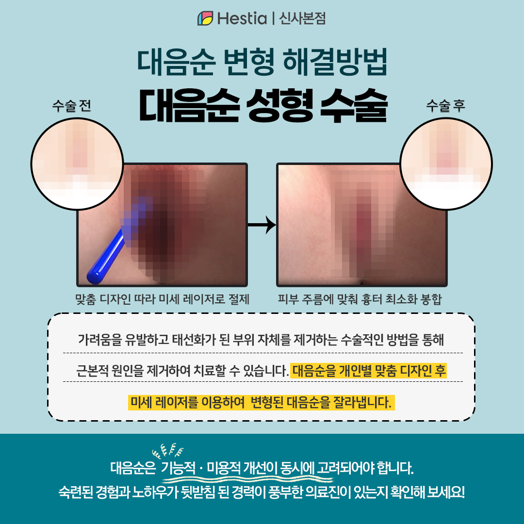 대음순 변형 치료방법 - 대음순성형수술