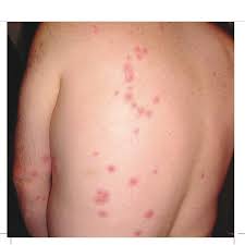 빈대 물린자국 : 빈대 퇴치법&amp;#44; 증상&amp;#44; 예방법