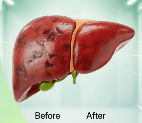  간경변&amp;#44; 정말 끝인가요? 반은 맞고 반은 틀려요!