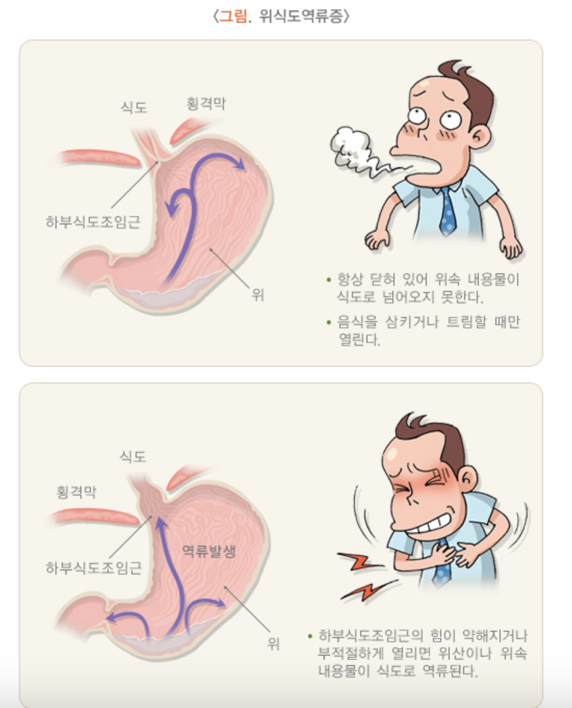 역류성식도염