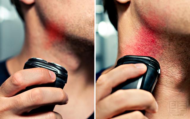 피부장벽 무너짐 증상 자연치유