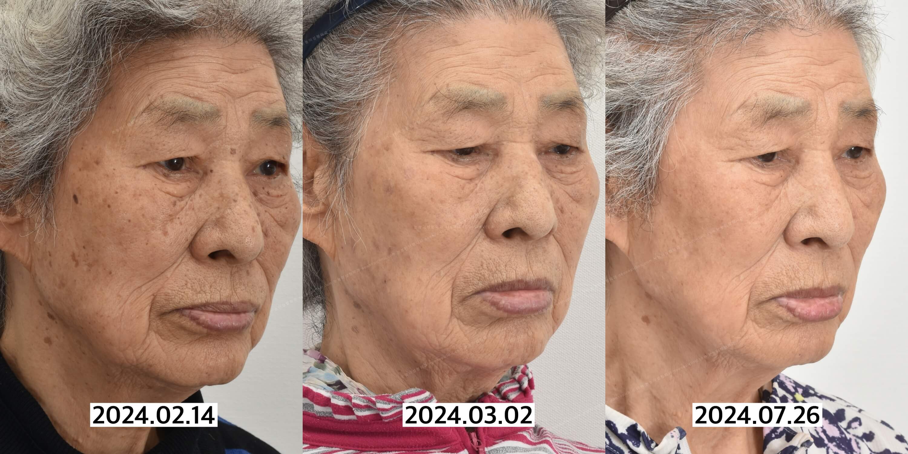 검버섯레이저
