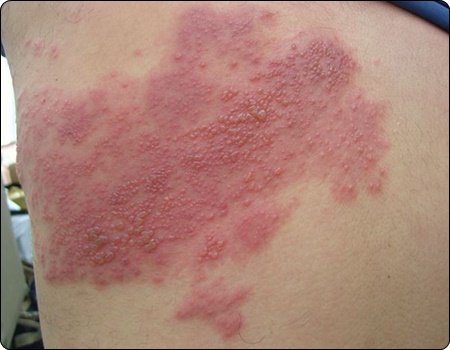 대상포진 예방접종 가격