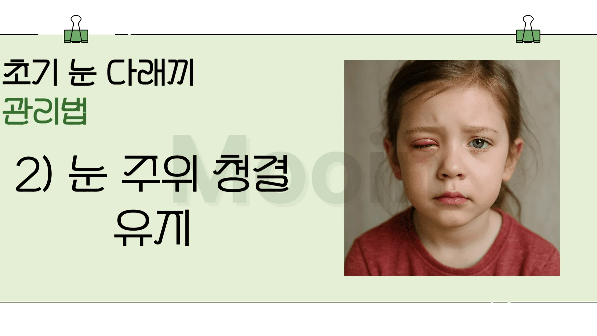 초기 눈 다래끼 관리법: 눈 주위 청결 유지