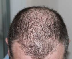 탈모약 필요성과 부작용 실비 청구 방법까지