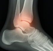 발목 접질렀을때