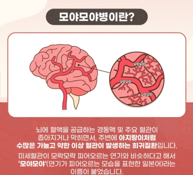 모야모야병 증상 원인 주의사항 치료